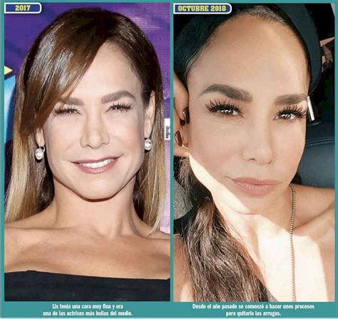 lis vega antes y después|Así lucía Lis Vega antes y después de las cirugías。